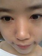 做了卧蚕眼手术瞬间变卧蚕美女