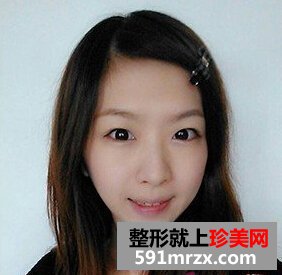 注射除皱效果怎么样