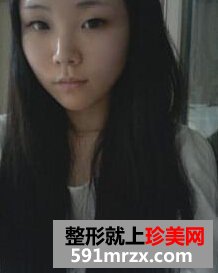 鼻头鼻翼缩小手术,我是一个大美女