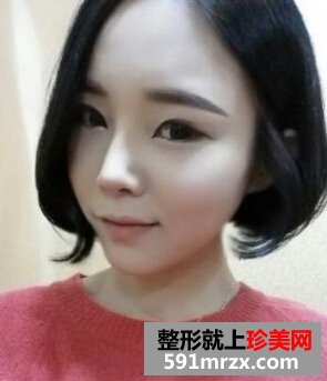 鼻头鼻翼缩小手术,我是一个大美女