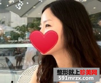 修复失败双眼皮