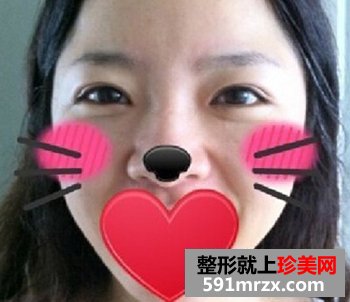 修复失败双眼皮