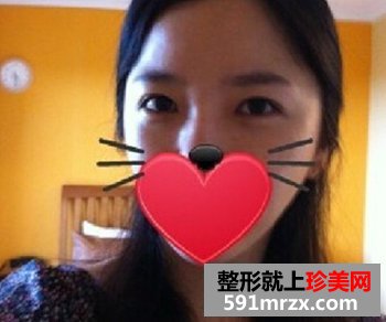 修复失败双眼皮
