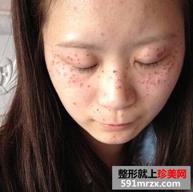 激光美容祛斑好不好