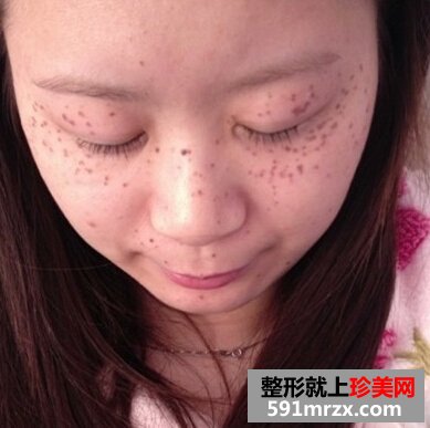 激光美容祛斑好不好