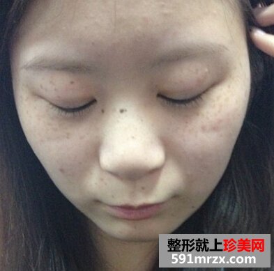 激光美容祛斑好不好