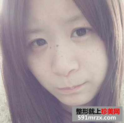 激光美容祛斑好不好
