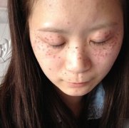 激光美容祛斑效果好不好