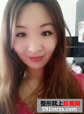 割双眼皮多久恢复