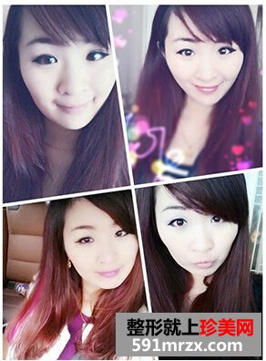 割双眼皮多久恢复