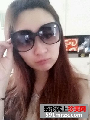 割双眼皮多久恢复