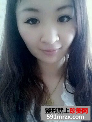 割双眼皮多久恢复