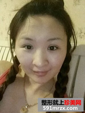 割双眼皮多久恢复