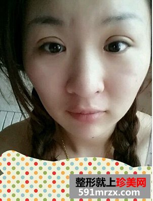 割双眼皮多久恢复