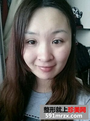 割双眼皮多久恢复
