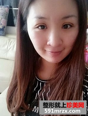 割双眼皮多久恢复