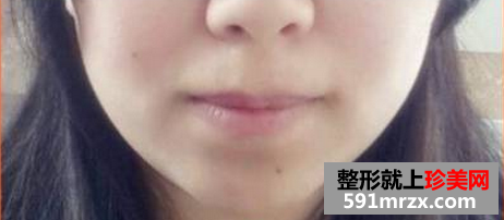 面部吸脂瘦脸+假体垫下巴 重生之女神养成计划