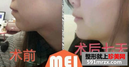 面部吸脂瘦脸+假体垫下巴 重生之女神养成计划