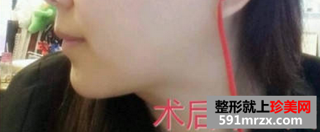 面部吸脂瘦脸+假体垫下巴 重生之女神养成计划