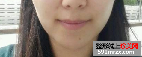 面部吸脂瘦脸+假体垫下巴 重生之女神养成计划