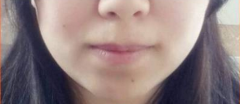 面部吸脂瘦脸+假体垫下巴重生之女神养成计划