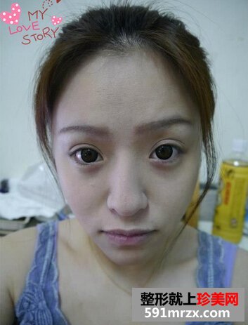 全面部自体脂肪填充,理想丰满现实骨感
