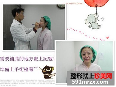 全面部自体脂肪填充,理想丰满现实骨感