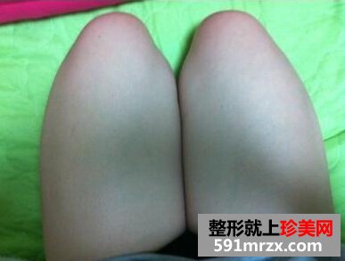 大腿部吸脂减肥,美腿志