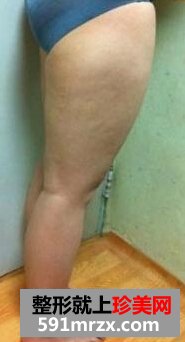 大腿部吸脂减肥,美腿志