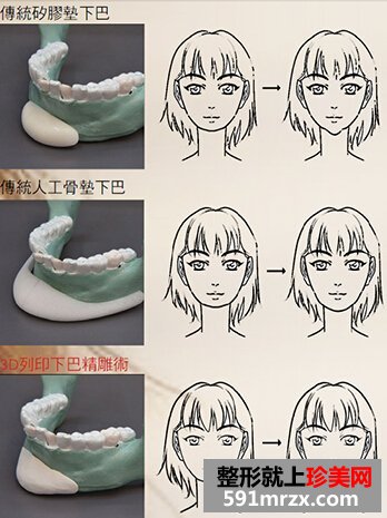 隆下巴整形