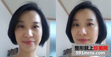 e光嫩肤