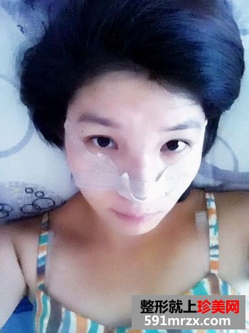 鼻子整形手术,人活一张脸