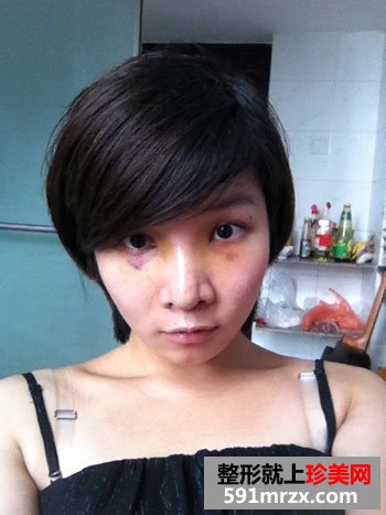 鼻子整形手术,人活一张脸
