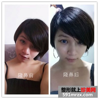 鼻子整形手术,人活一张脸