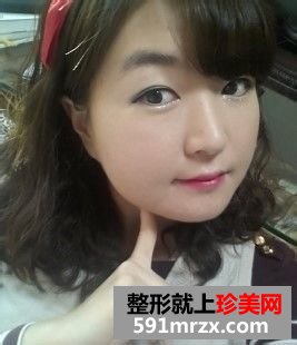 女人尖下颌角整形