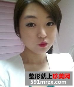 女人尖下颌角整形