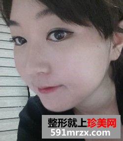 女人尖下颌角整形