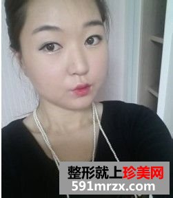 女人尖下颌角整形