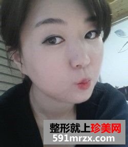 女人尖下颌角整形