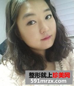 女人尖下颌角整形