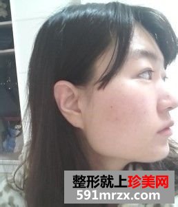 女人尖下颌角整形