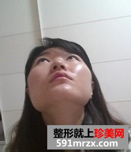 女人尖下颌角整形