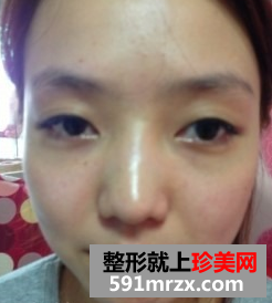 韩式双眼皮前后对比,丑女也有出头天
