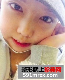 韩式双眼皮前后对比,丑女也有出头天