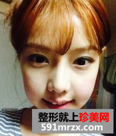 韩式双眼皮前后对比,丑女也有出头天