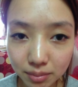 假体隆鼻+下颌角+韩式双眼皮前后对比