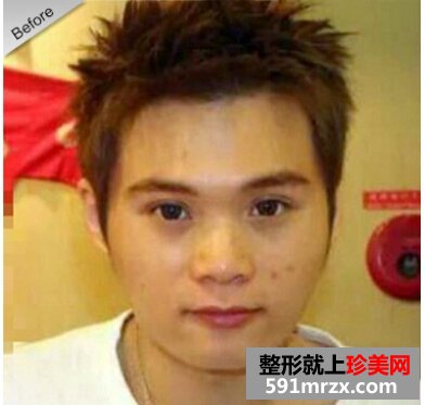 韩式纳米仿真隆鼻术,流浪汉变帅哥
