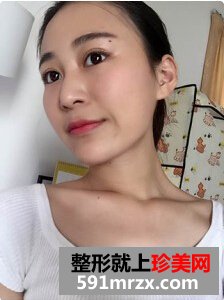 膨体隆鼻后取出假体,打玻尿酸隆鼻子