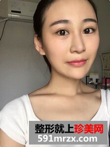 膨体隆鼻后取出假体,打玻尿酸隆鼻子
