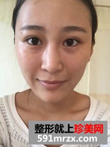 膨体隆鼻后取出假体,打玻尿酸隆鼻子